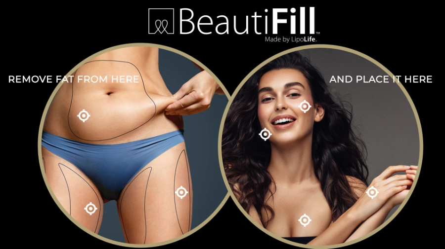 BeautiFill Treatment in Casper, WY | New Beautiful You