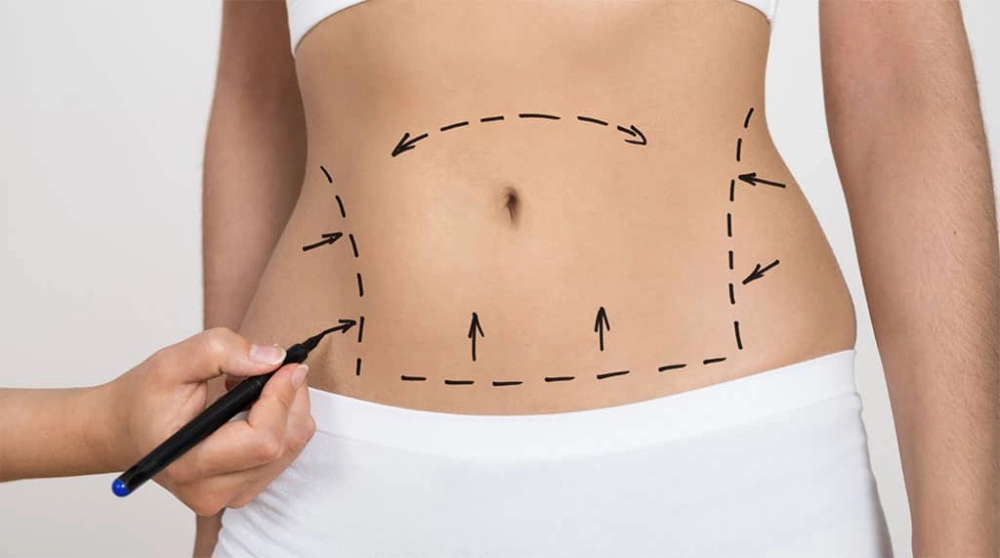 Tummy Tuck Surgery in Casper, WY - New Beautiful You