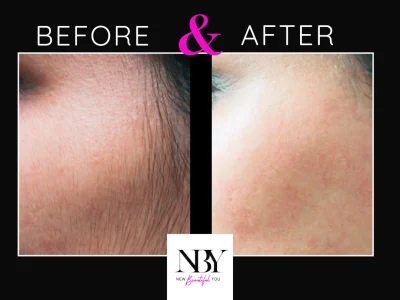New Beautiful You Laser Hair Removal Before and After Image A in Casper, WY