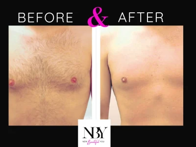 New Beautiful You Laser Hair Removal Before and After in Casper, WY