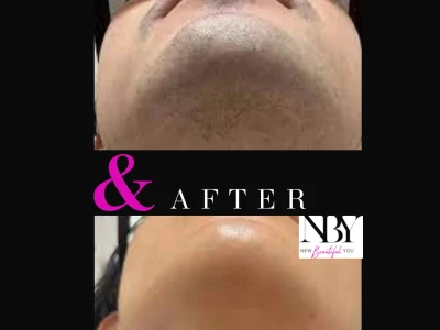 New Beautiful You Laser Hair Removal Before and After in Casper, WY