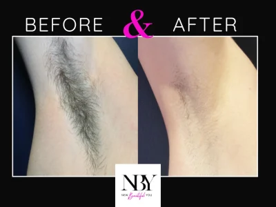 New Beautiful You Laser Hair Removal Before and After in Casper, WY