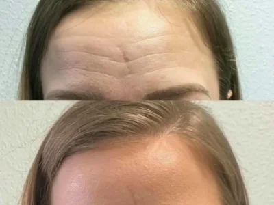 New Beautiful You botox ba d in Casper, WY