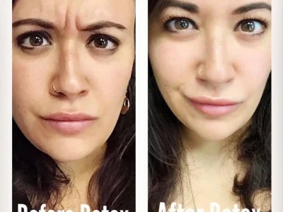 New Beautiful You botox ba e in Casper, WY