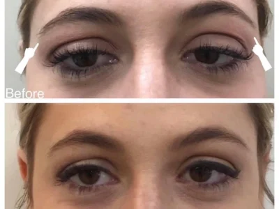 New Beautiful You botox ba f in Casper, WY