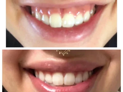 New Beautiful You botox ba g in Casper, WY