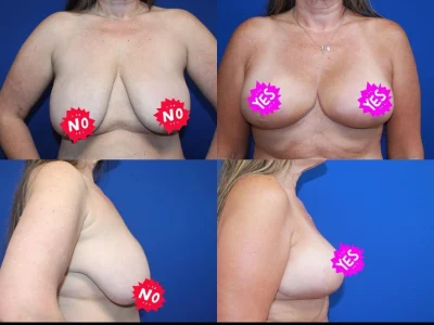 New Beautiful You breast lift ba c in Casper, WY