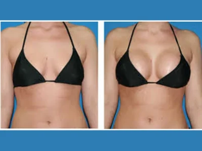 New-Beautiful-You-breast-lift-ba-e-in-Casper-WY