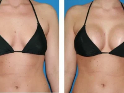 New Beautiful You breast lift ba h in Casper, WY