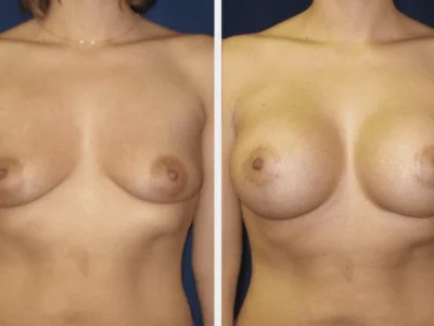 New Beautiful You breast lift ba i in Casper, WY