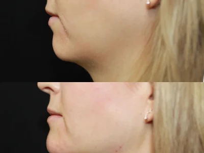 New Beautiful You cheek chin filler ba a in Casper, WY
