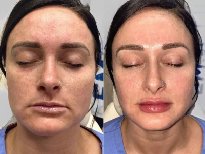 New Beautiful You cheek chin filler ba b in Casper, WY