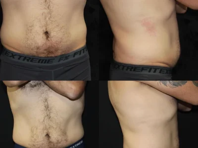 New Beautiful You coolsculpting ba a in Casper, WY