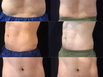 New Beautiful You coolsculpting ba b in Casper, WY