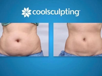New Beautiful You coolsculpting ba d in Casper, WY