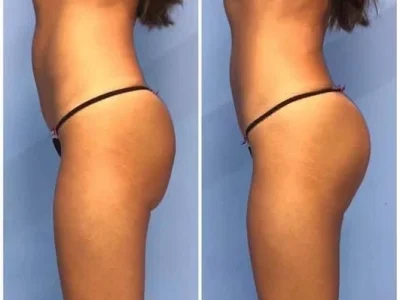 New Beautiful You emsculpt ba a in Casper, WY