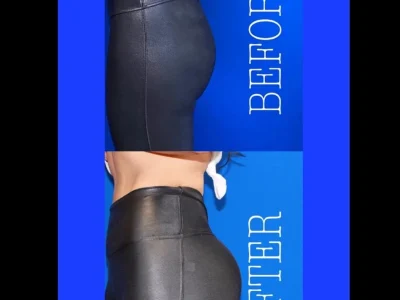 New Beautiful You emsculpt ba b in Casper, WY