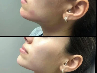 New Beautiful You jawline filler ba a in Casper, WY