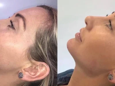 New Beautiful You jawline filler ba b in Casper, WY