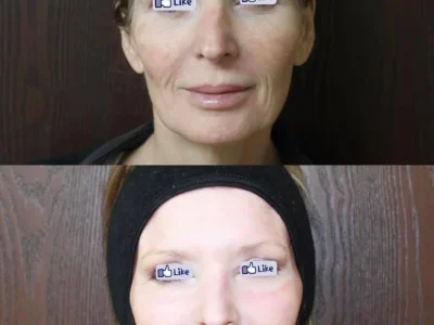 New Beautiful You laser resurfacing ba b in Casper, WY