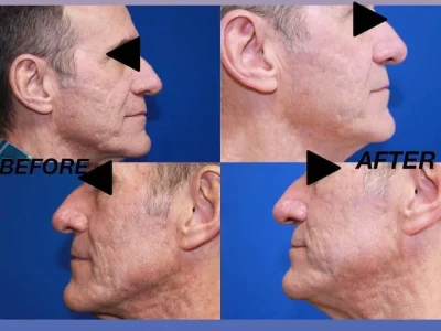 New Beautiful You laser resurfacing ba c in Casper, WY