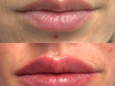 New Beautiful You lip filler ba a in Casper, WY