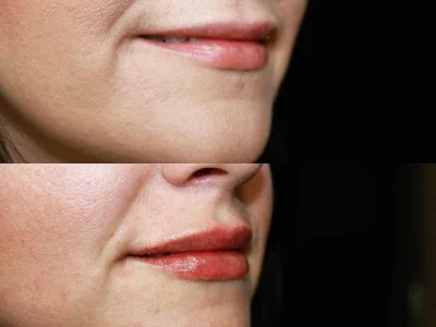 New Beautiful You lip filler ba b in Casper, WY