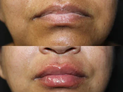 New Beautiful You lip filler ba c in Casper, WY