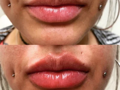 New Beautiful You lip filler ba d in Casper, WY