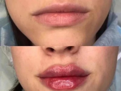 New Beautiful You lip filler ba h in Casper, WY