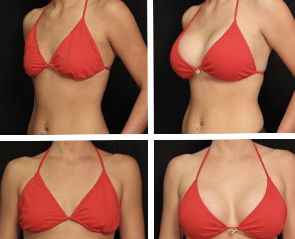 Breast Lift With Implants Before and After