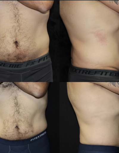 Cool sculpting before and after