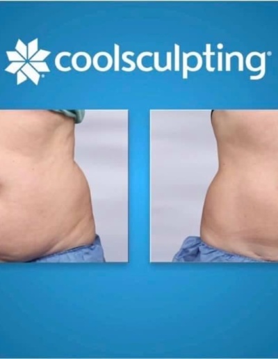 Cool Sculpting before and after