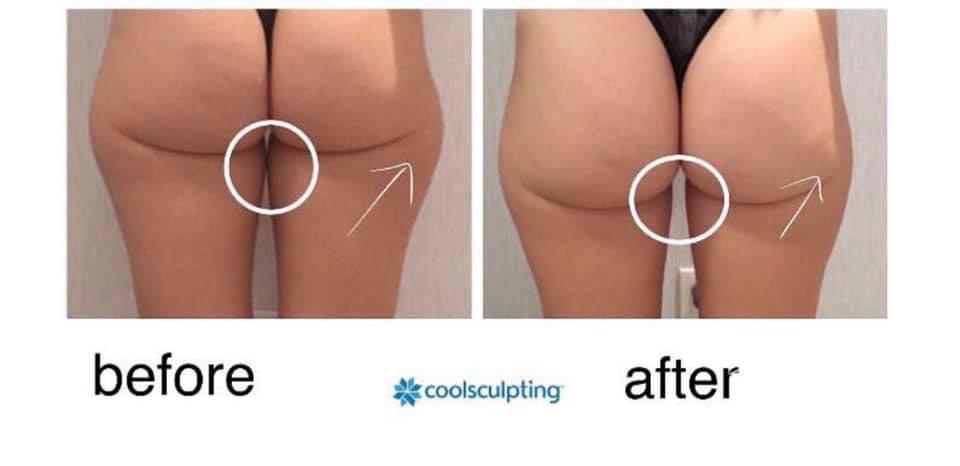 Cool sculpting before and after