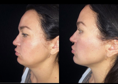 Custom Contour before and after