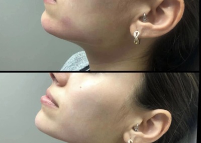 Jawline filler before and after