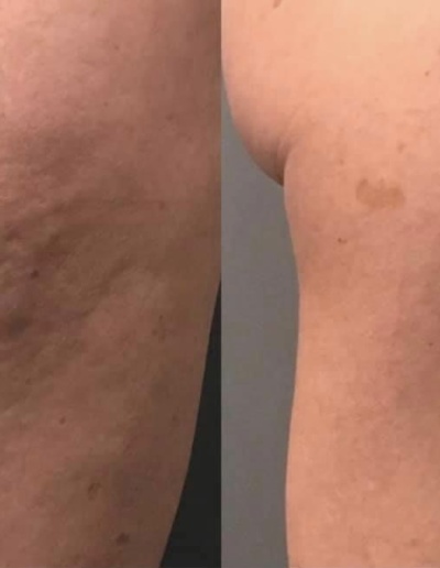 QWO Cellulite before and after